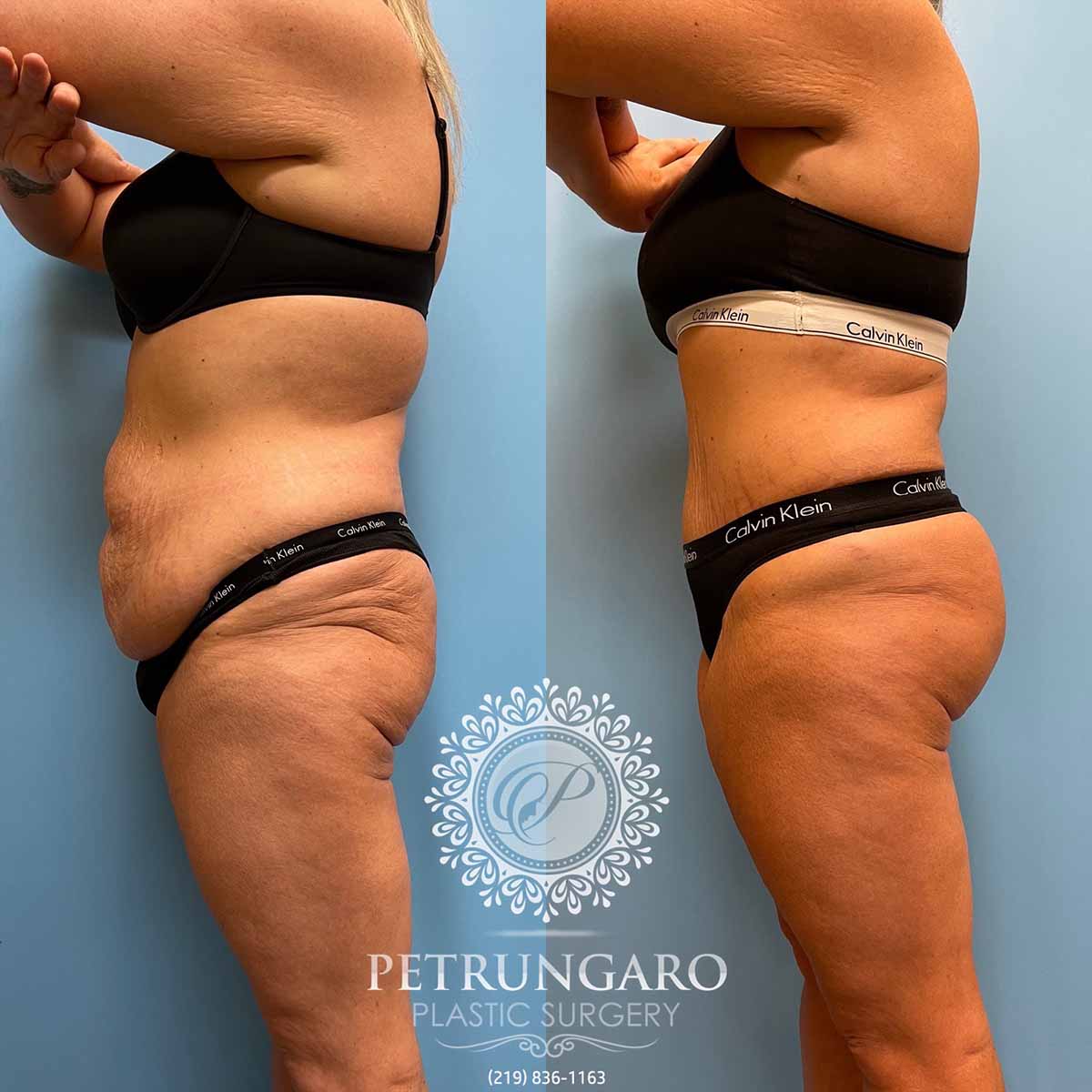 tummy-tuck-liposuction-360-brazilian-butt-lift-2