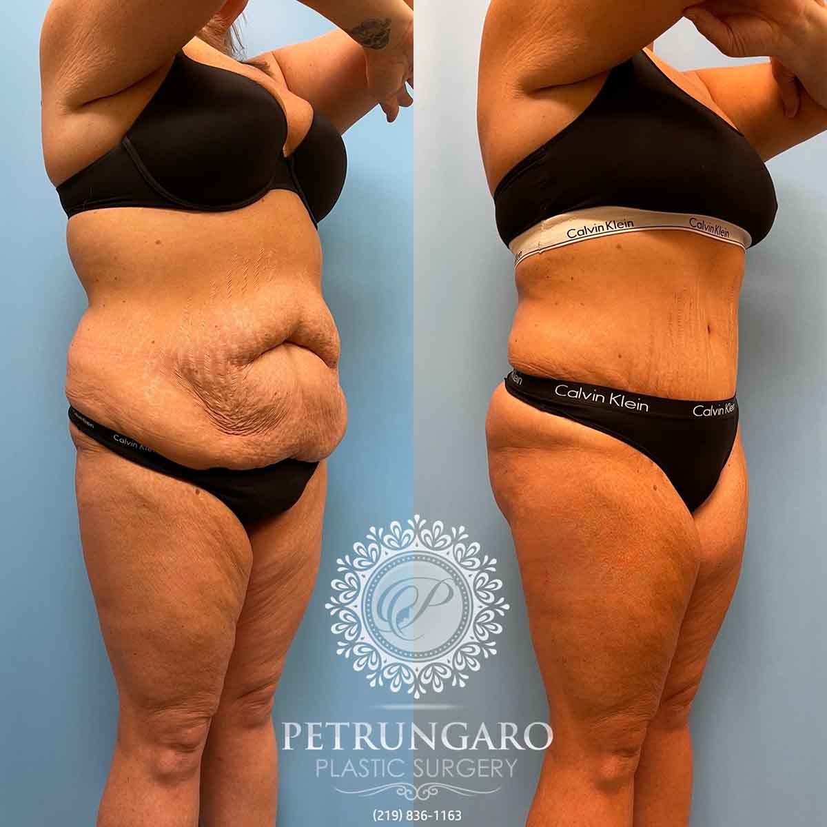 tummy-tuck-liposuction-360-brazilian-butt-lift-4