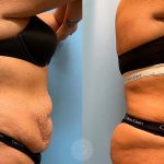 tummy-tuck-liposuction-360-brazilian-butt-lift-featured