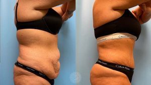 tummy-tuck-liposuction-360-brazilian-butt-lift-featured