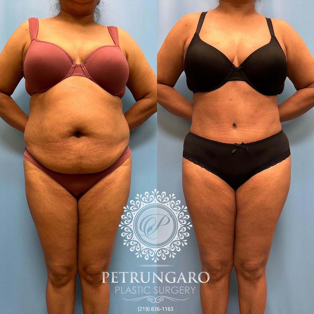 Platinum Tummy Tuck with Lipo 360 Before & After - 1