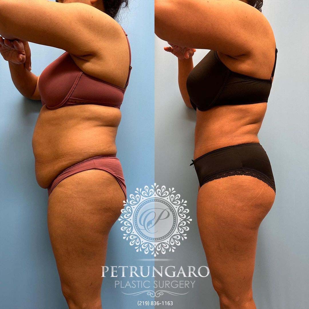 Platinum Tummy Tuck with Lipo 360 Before & After - 2