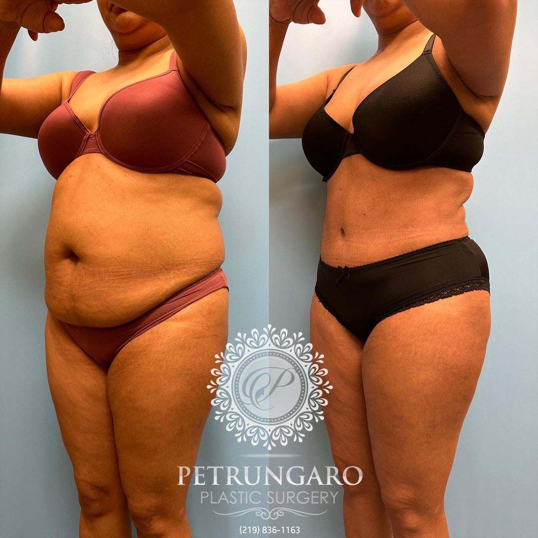 Platinum Tummy Tuck with Lipo 360 Before & After - 3