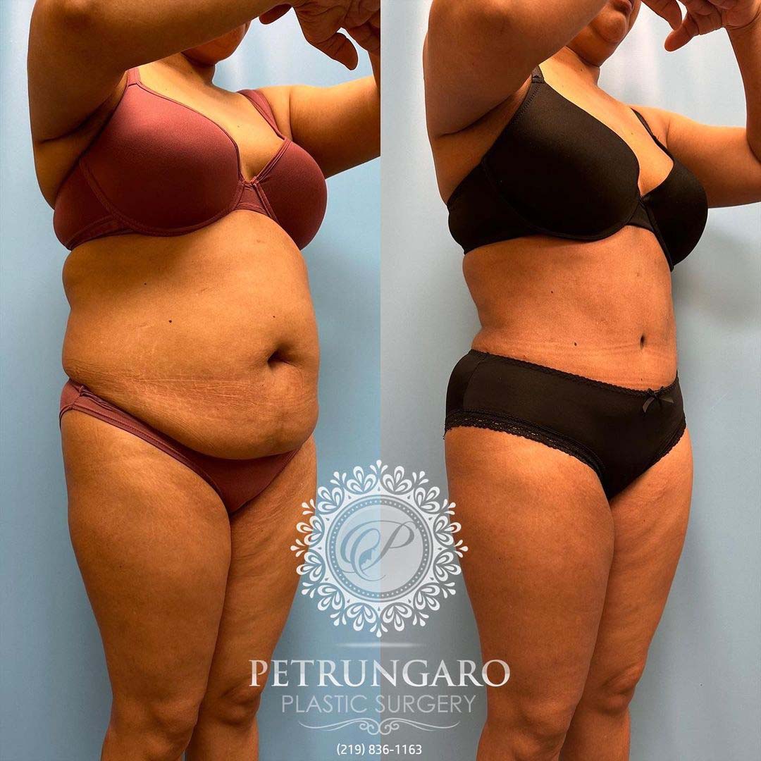 Platinum Tummy Tuck with Lipo 360 Before & After - 5