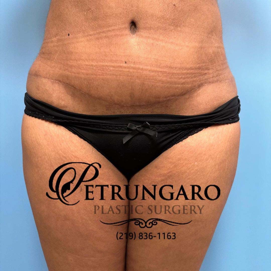 Platinum Tummy Tuck with Lipo 360 Before & After - 6