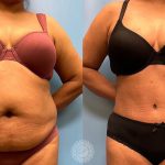 Platinum Tummy Tuck with Lipo 360 Before & After - featured