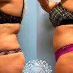 Platinum Tummy Tuck with Lipo 360 - featured