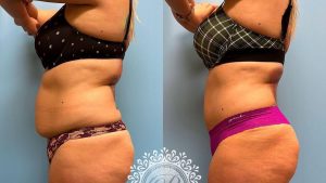Platinum Tummy Tuck with Lipo 360 - featured
