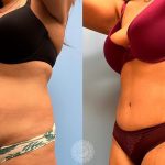 Platinum Tummy Tuck with Lipo 360-featured