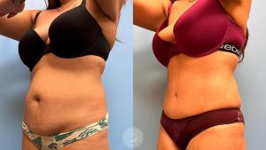 Platinum Tummy Tuck with Lipo 360-featured