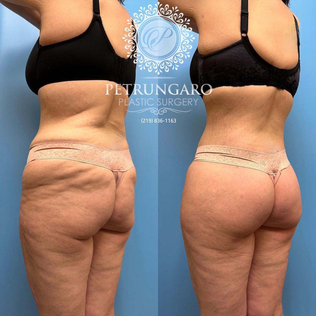 body lift Lipo 360 Renuvion skin tightening and fat transfer -1