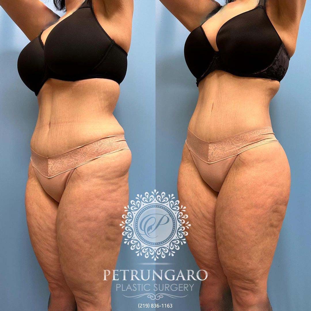 body lift Lipo 360 Renuvion skin tightening and fat transfer -4