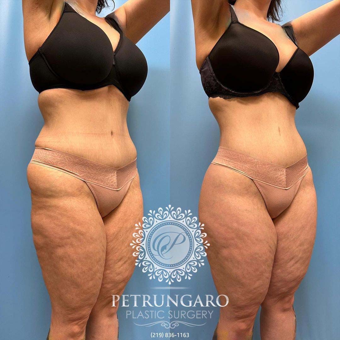 body lift Lipo 360 Renuvion skin tightening and fat transfer -6
