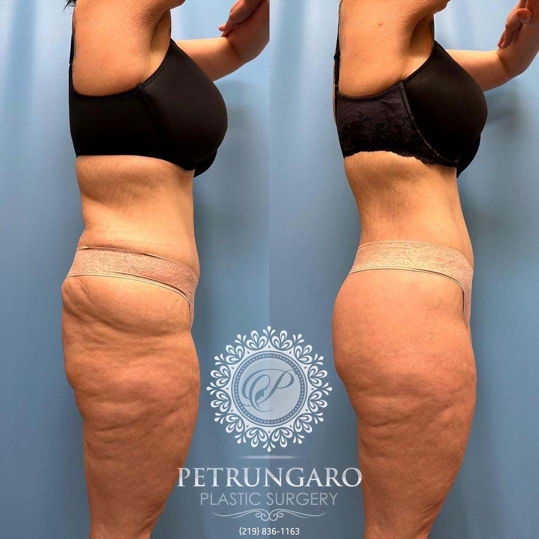 body lift Lipo 360 Renuvion skin tightening and fat transfer -7