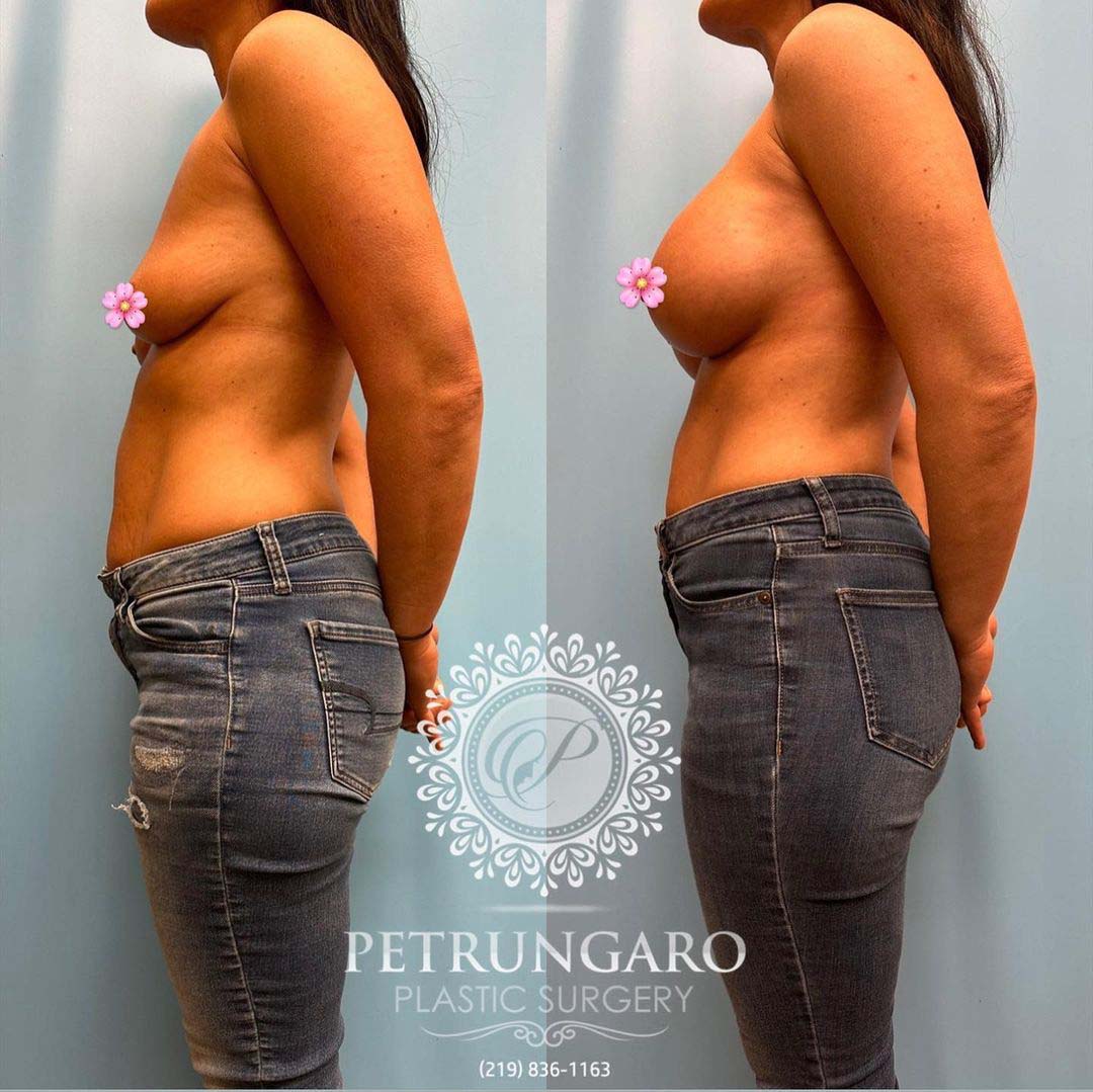 breast-augmentation-3-before-after