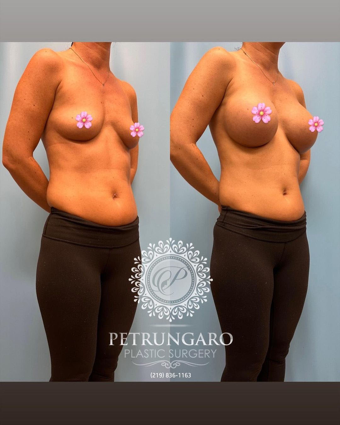 breast-augmentation-4-before-after