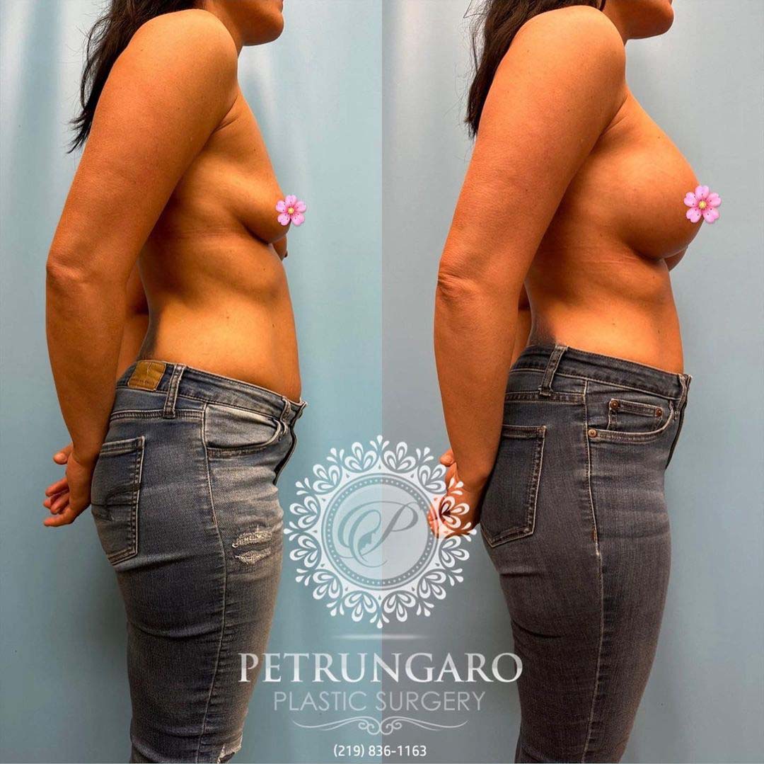 breast-augmentation-5-before-after