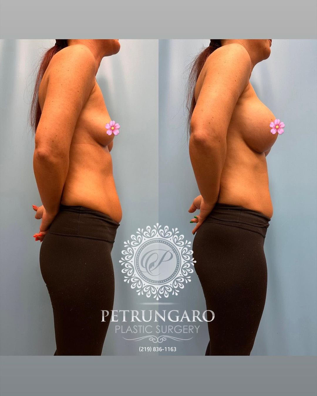 breast-augmentation-5-before-after