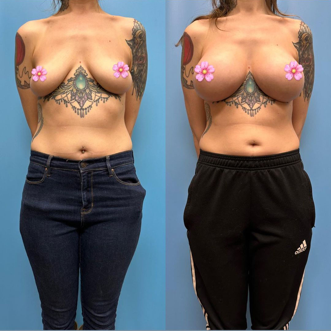 breast-augmentation-before-after-1