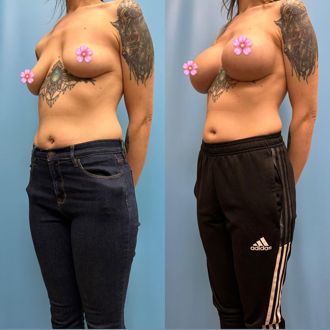 breast-augmentation-before-after-2