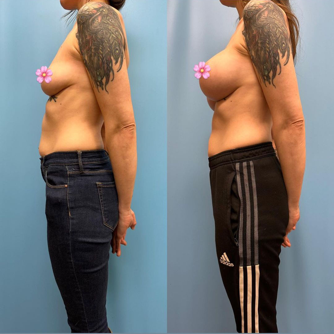 breast-augmentation-before-after-3