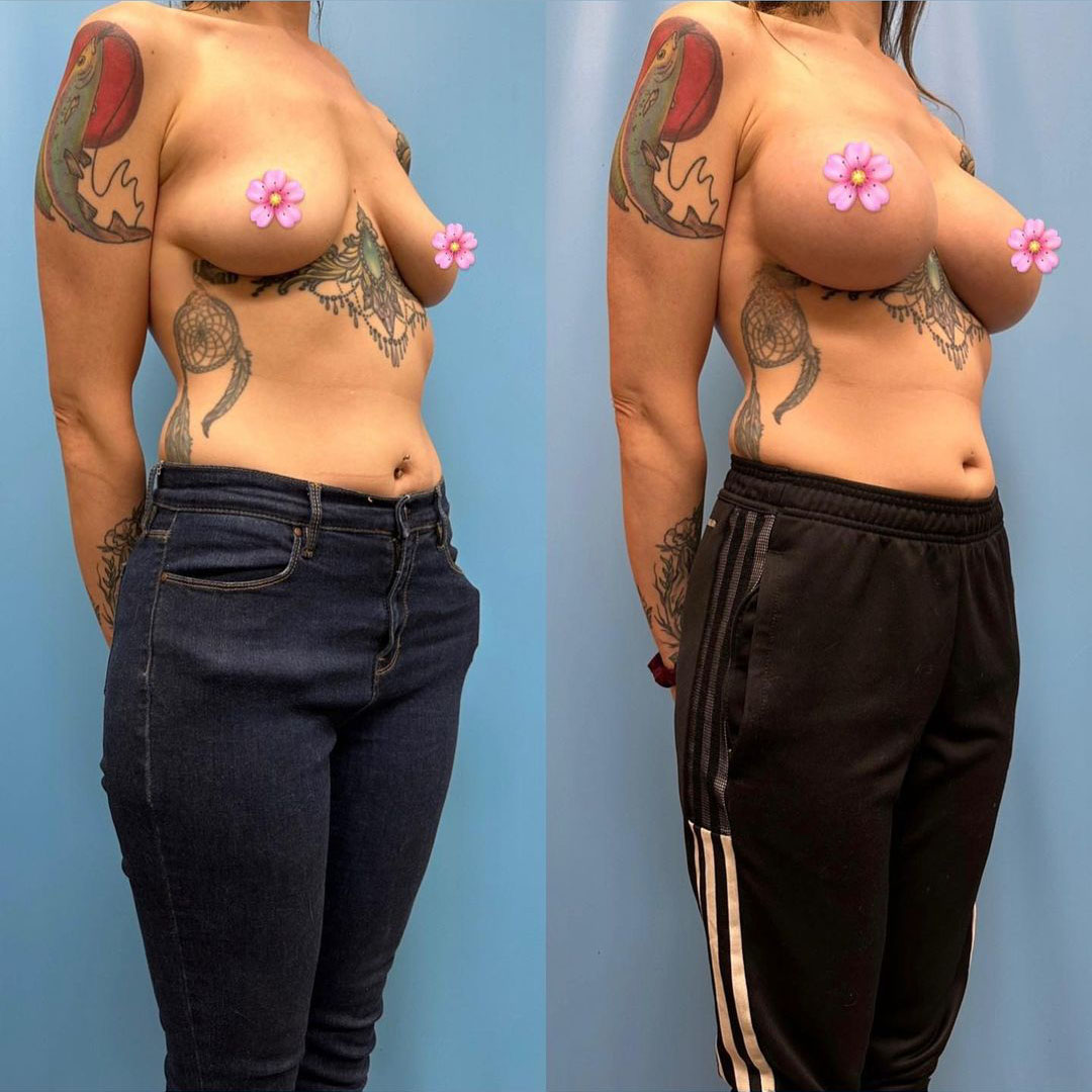 breast-augmentation-before-after-4
