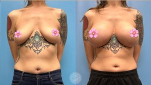 breast-augmentation-before-after-featured