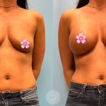 breast-augmentation-featured