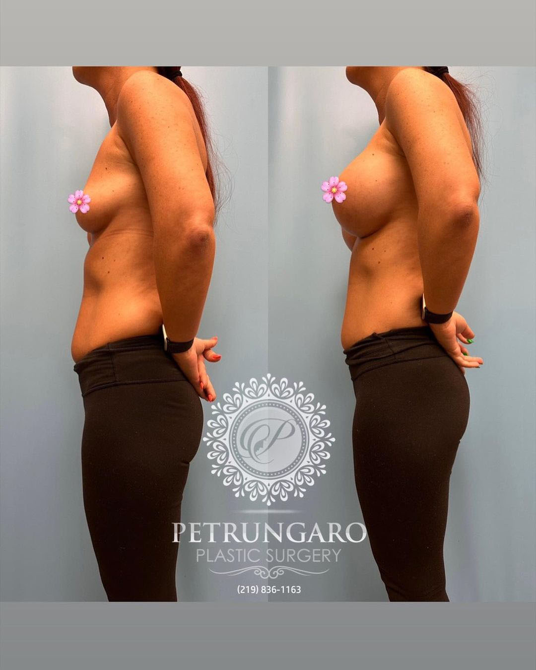 breast-augmentation-3-before-after