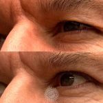 upper blepharoplasty eyelid lift featured