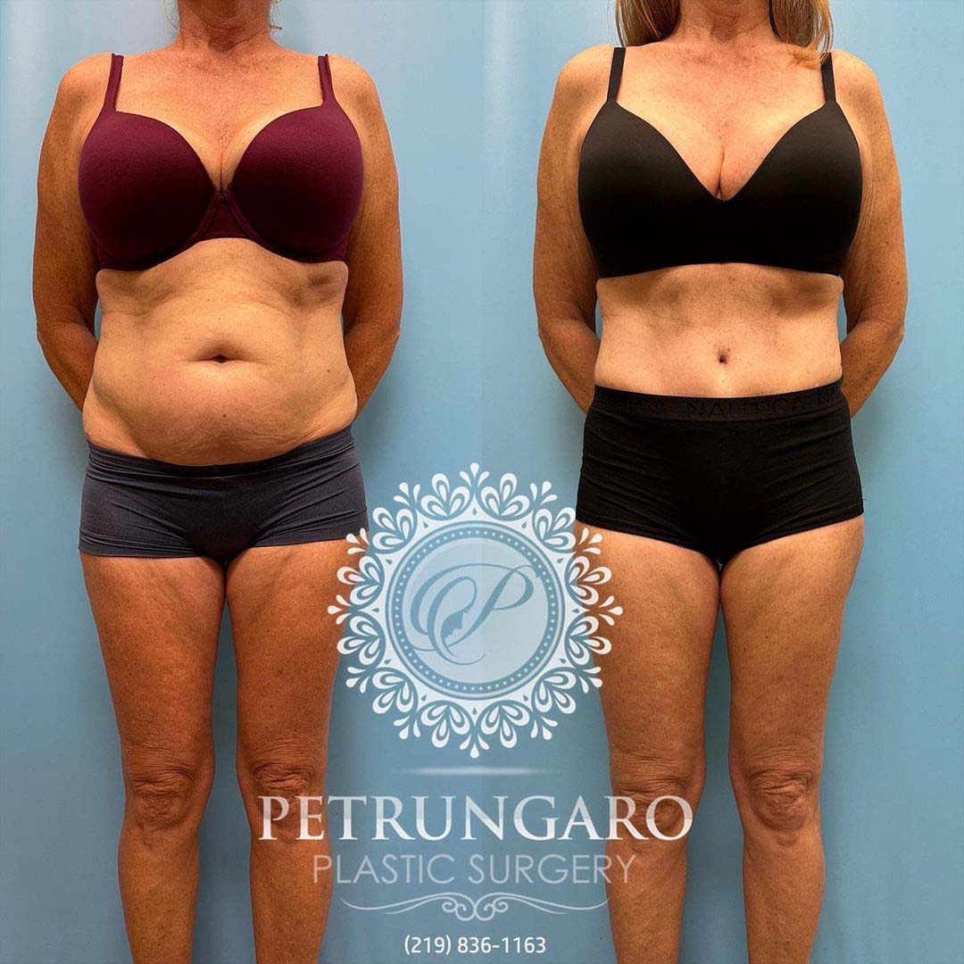 Platinum Tummy Tuck with Lipo 360 before and after-1