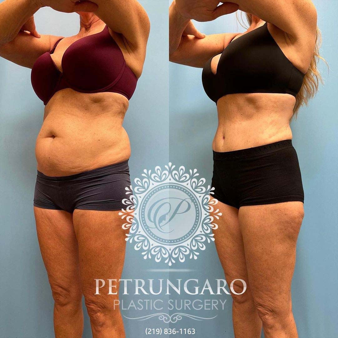 Platinum Tummy Tuck with Lipo 360 before and after-3