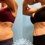 Platinum Tummy Tuck with Lipo 360 before and after-featured