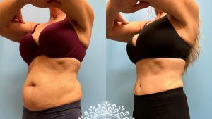 Platinum Tummy Tuck with Lipo 360 before and after-featured