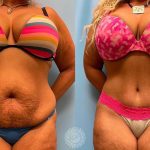 Platinum Tummy Tuck with Lipo 360 -featured