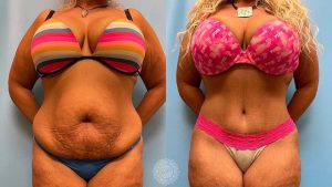 Platinum Tummy Tuck with Lipo 360 -featured