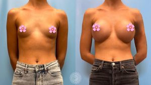 breast-augmentation-before-and-after-featured