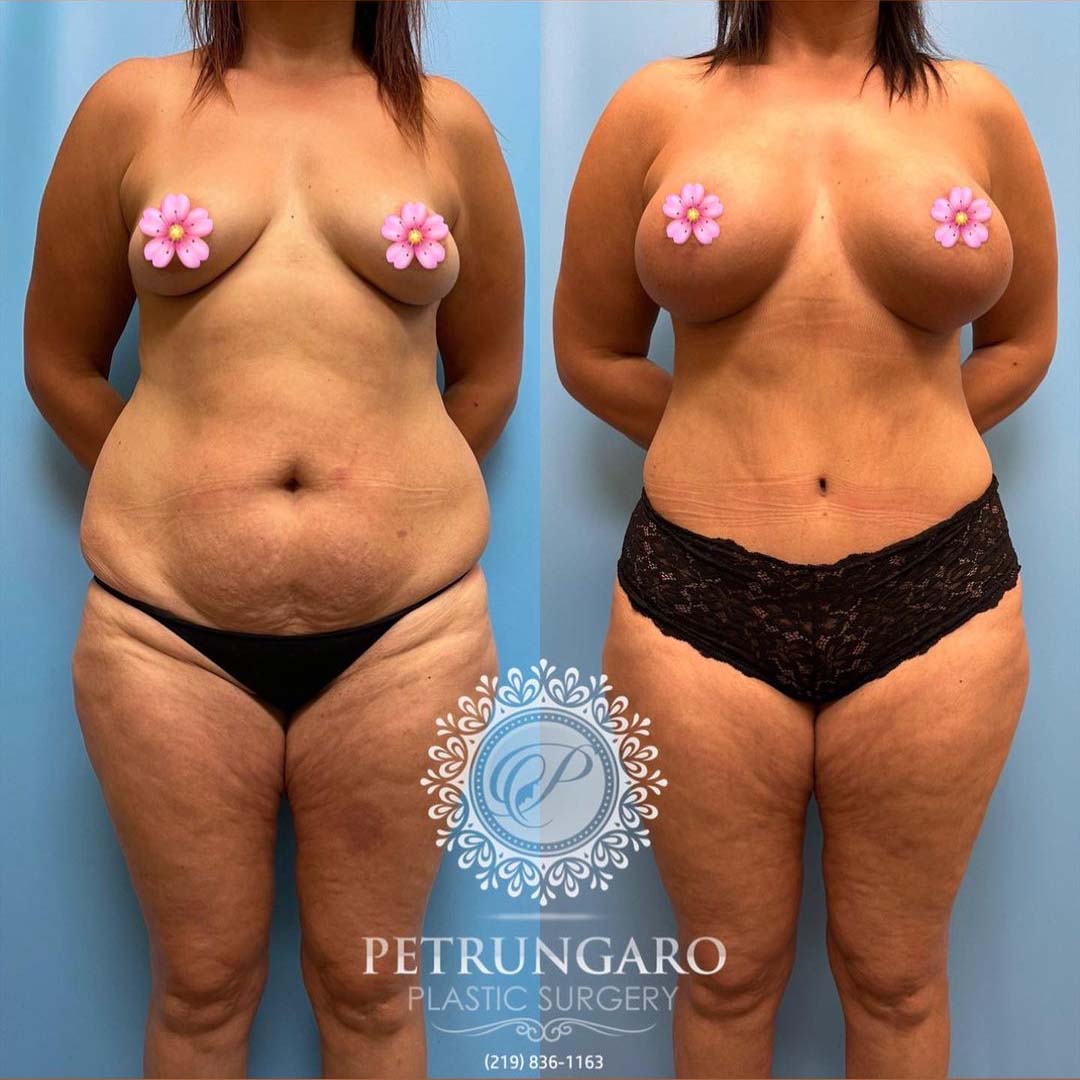periareolar-donut-breast-lift-with-implants-tummy-tuck-with-Lipo-360-1