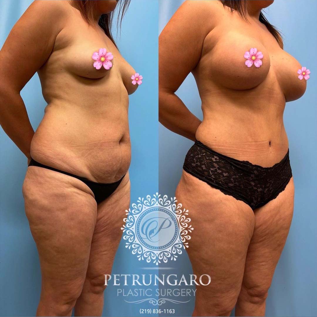 periareolar-donut-breast-lift-with-implants-tummy-tuck-with-Lipo-360-2
