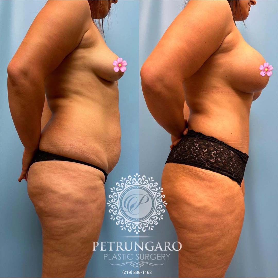 periareolar-donut-breast-lift-with-implants-tummy-tuck-with-Lipo-360-3
