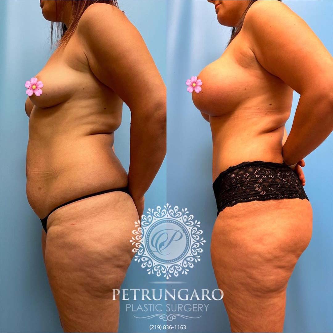 periareolar-donut-breast-lift-with-implants-tummy-tuck-with-Lipo-360-5