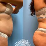 tummy tuck - Lipo 360 - Brazilian Butt Lift before and after -featured
