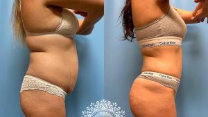 tummy tuck - Lipo 360 - Brazilian Butt Lift before and after -featured