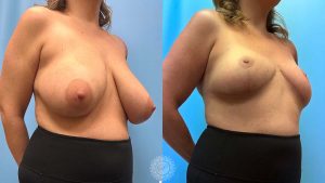 34-f-breast-reduction-featured