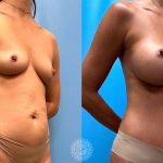 37-f-mommy-makeover-tummy-tuck-liposuction-featured