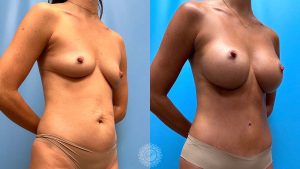 37-f-mommy-makeover-tummy-tuck-liposuction-featured