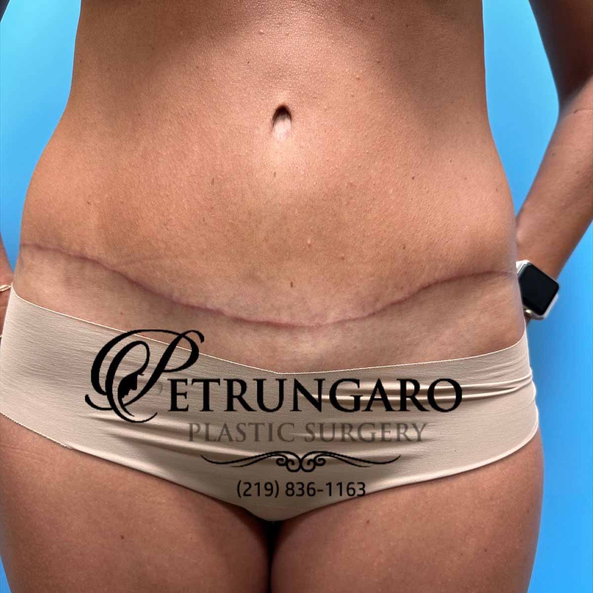 37-f-tummy-tuck-liposuction-360-1