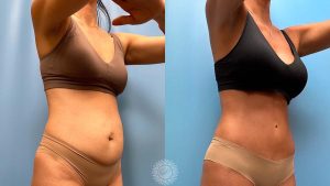 37-f-tummy-tuck-liposuction-360-featured