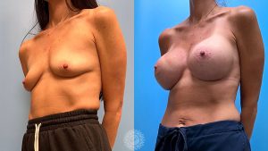 43-f-natrelle-breast-implants-featured