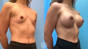 Breast-augmentation-Natrelle-implants-featured